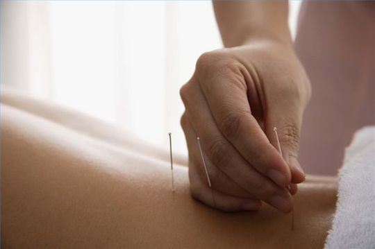 woman undergoing acupuncture