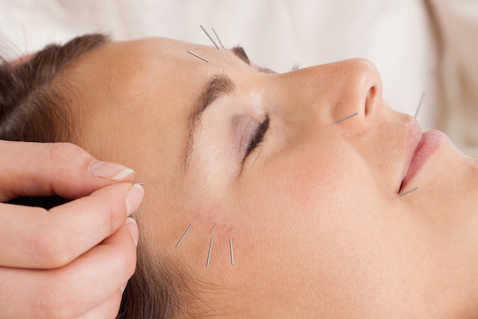 Acupuncture Provided By Vancouver Acupuncturist