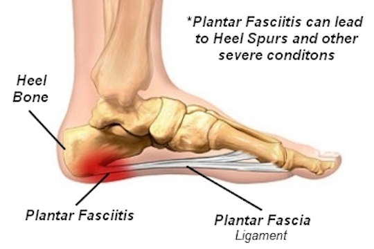 Plantar Fascitis Treatment Offered by Vancouver Chiropractor