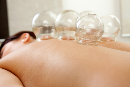 Cupping Provided by Vancouver Acupuncturist